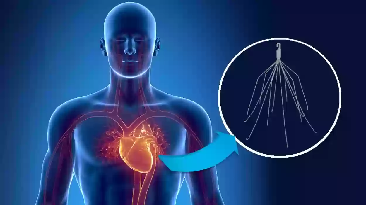 إصابتها بجلطة وتمزق بالشريان